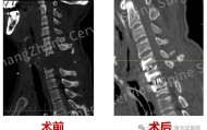 全球罕见！“身首离断”患者被救回 主刀医生：术毕两月整，已脱离呼吸机半月